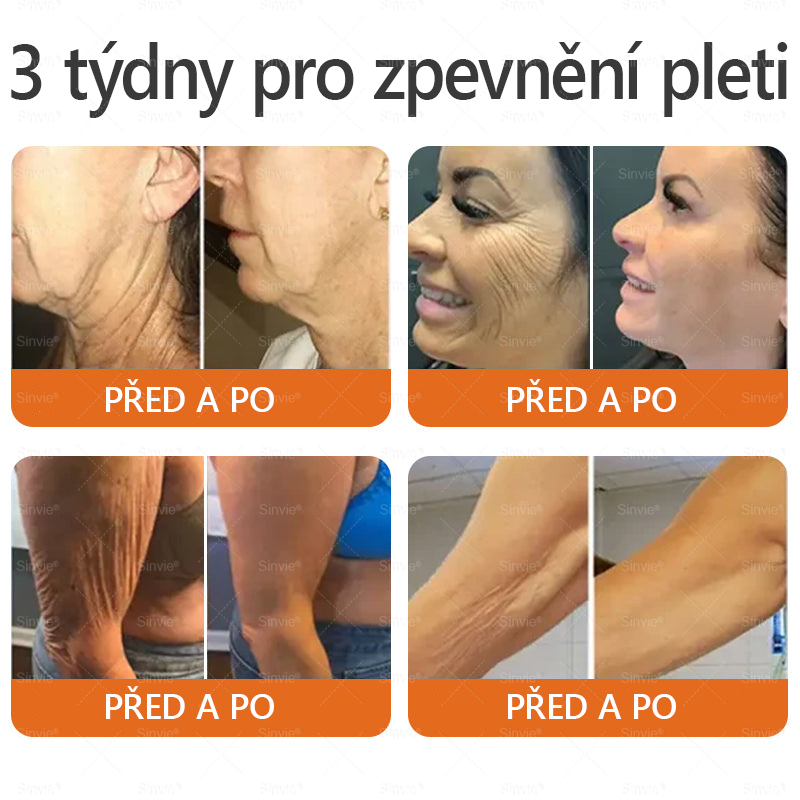 👨‍⚕‍🐝 Sinvie® Krém na obnovu pleti s včelím jedem(👨‍⚕‍CE schváleno)👍✅