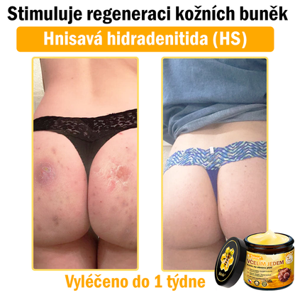 🔥🐝 Sinvie® Krém na obnovu pleti s včelím jedem(👨‍⚕‍CE certifikace)👍✅