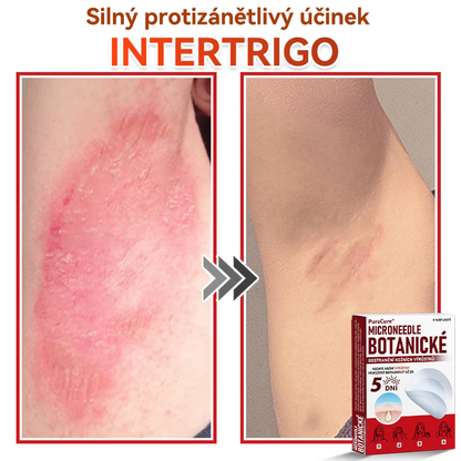✨PuraCure® Mikrojehličková botanická náplast na odstranění bradavic(✅CE certifikace)👍