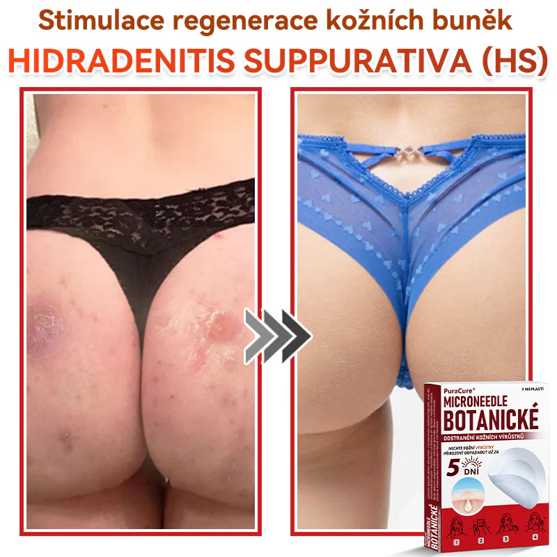 ✨PuraCure® Mikrojehličková botanická náplast na odstranění bradavic(✅CE certifikace)👍