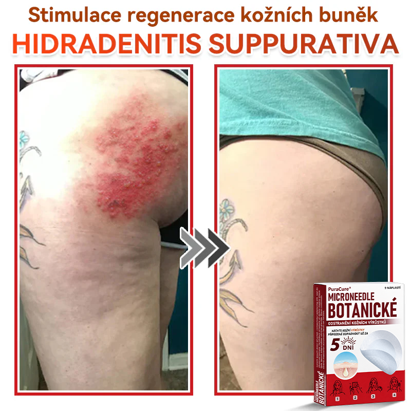 ✨PuraCure® Mikrojehličková botanická náplast na odstranění bradavic(✅CE certifikace)👍