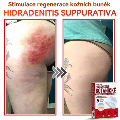 ✨PuraCure® Mikrojehličková botanická náplast na odstranění bradavic(✅CE certifikace)👍