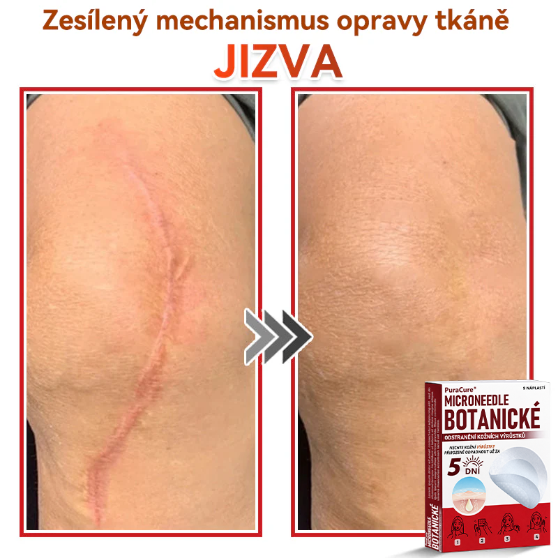 ✨PuraCure® Mikrojehličková botanická náplast na odstranění bradavic(✅CE certifikace)👍