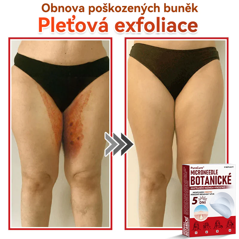 ✨PuraCure® Mikrojehličková botanická náplast na odstranění bradavic(✅CE certifikace)👍