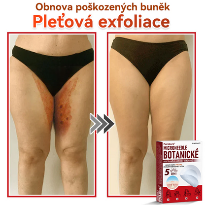 ✨PuraCure® Mikrojehličková botanická náplast na odstranění bradavic(✅CE certifikace)👍