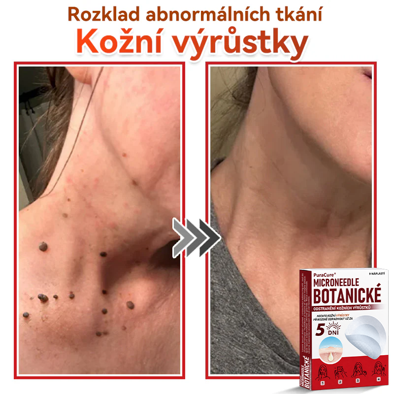 ✨PuraCure® Mikrojehličková botanická náplast na odstranění bradavic(✅CE certifikace)👍
