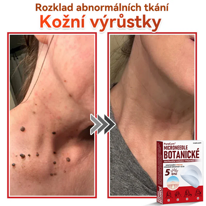 ✨PuraCure® Mikrojehličková botanická náplast na odstranění bradavic(✅CE certifikace)👍