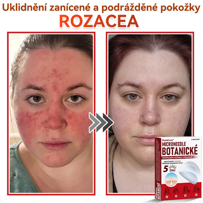 ✨PuraCure® Mikrojehličková botanická náplast na odstranění bradavic(✅CE certifikace)👍