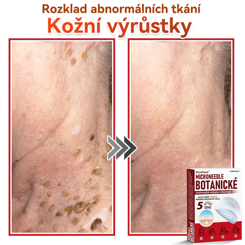 ✨PuraCure® Mikrojehličková botanická náplast na odstranění bradavic(✅CE certifikace)👍