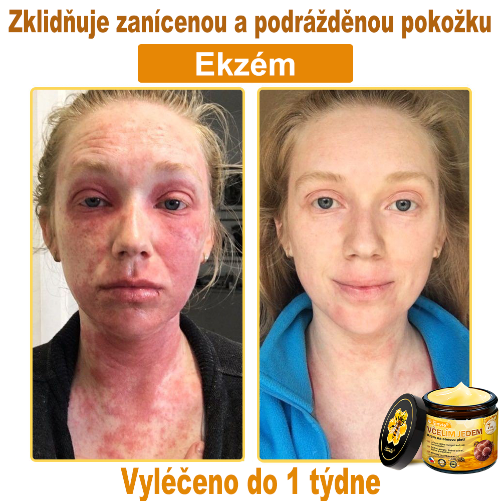 🐝 Sinvie® Krém na obnovu pleti s včelím jedem(👨‍⚕‍Výroba probíhá v souladu s normami GMP)👍✅