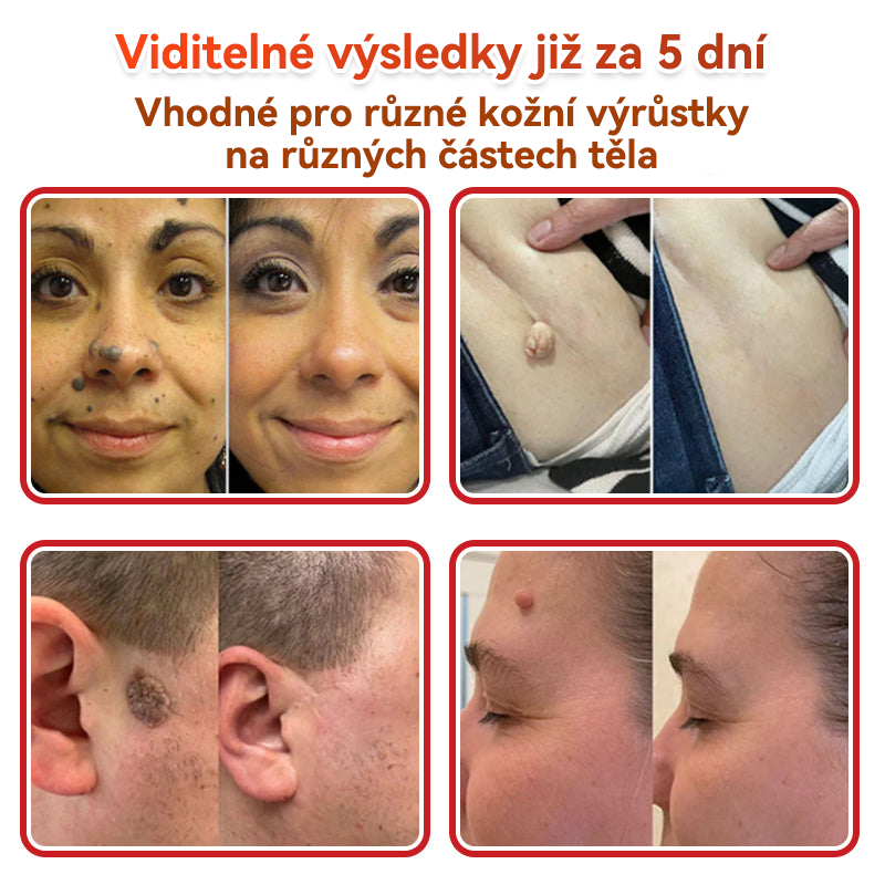 ✨PuraCure® Mikrojehličková botanická náplast na odstranění bradavic(✅CE certifikace)👍
