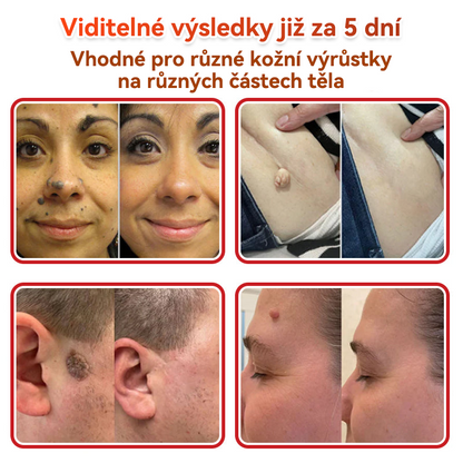 ✨PuraCure® Mikrojehličková botanická náplast na odstranění bradavic(✅CE certifikace)👍